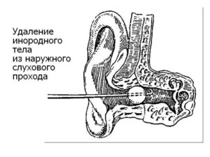 Удаление инородного тела из уха